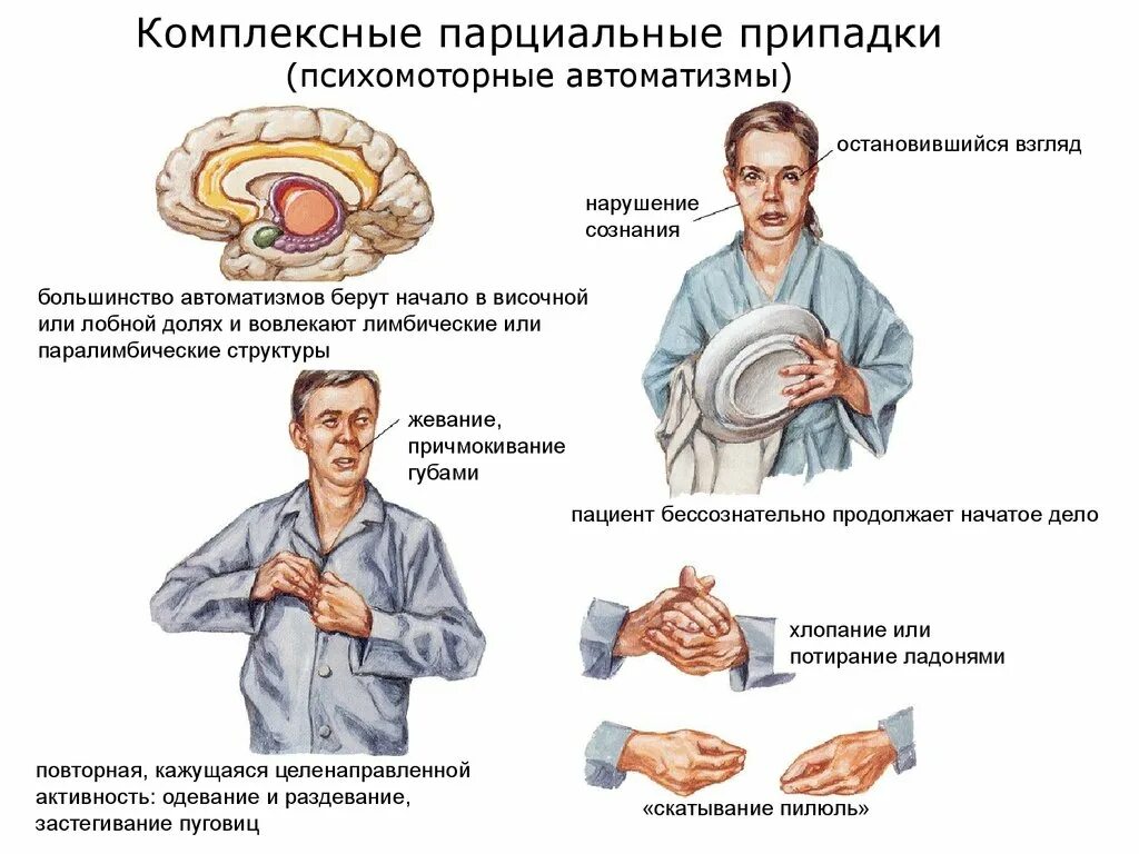 Сложные парциальные припадки. Сложные парциальные приступы при эпилепсии. Комплексные парциальные припадки. Простые парциальные припадки эпилепсии симптомы. Фокальные припадки