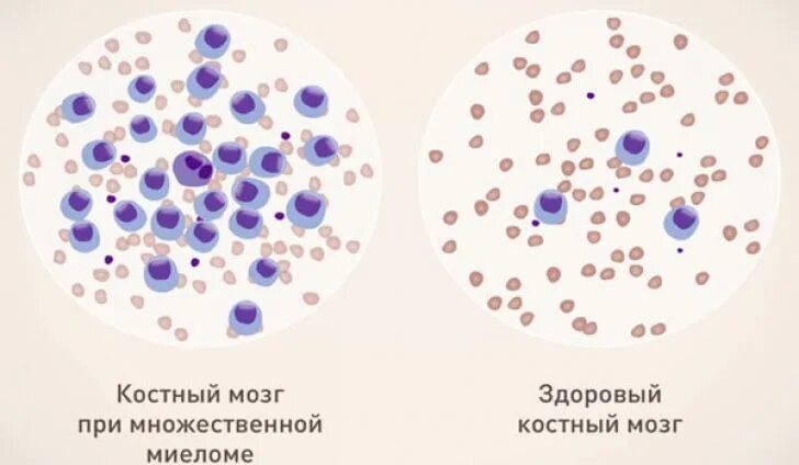 Костный мозг при множественной миеломе. Клетки костного мозга при множественной миеломе. Множественная миелома картина крови. Картина крови при миеломной болезни. Множественные исследования