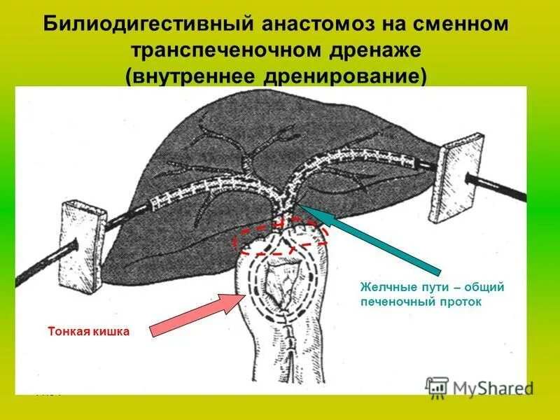 Виды наружного и внутреннего дренирования холедоха. Внутреннее дренирование холедоха. Наружное и внутреннее дренирование желчных путей. Механической желтухи дренирование желчных. Т образное дренирование холедоха.