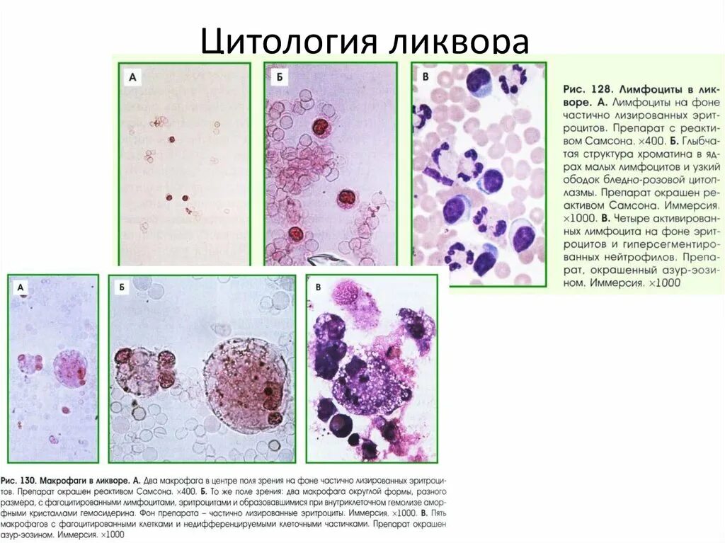 Макрофаги в молочной. Цитология ликвора микроскопия. Мазок ликвора микроскопия. Клеточные элементы при микроскопии ликвора. Микроскопия ликвора норма патология.