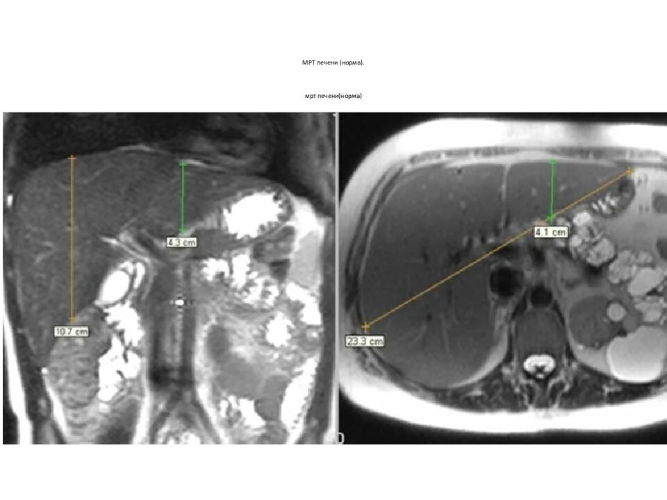 Измерение размеров печени на кт. Краниокаудальный размер печени на кт. Сегментация печени мрт. Размеры печени на кт норма. Кт норма печень