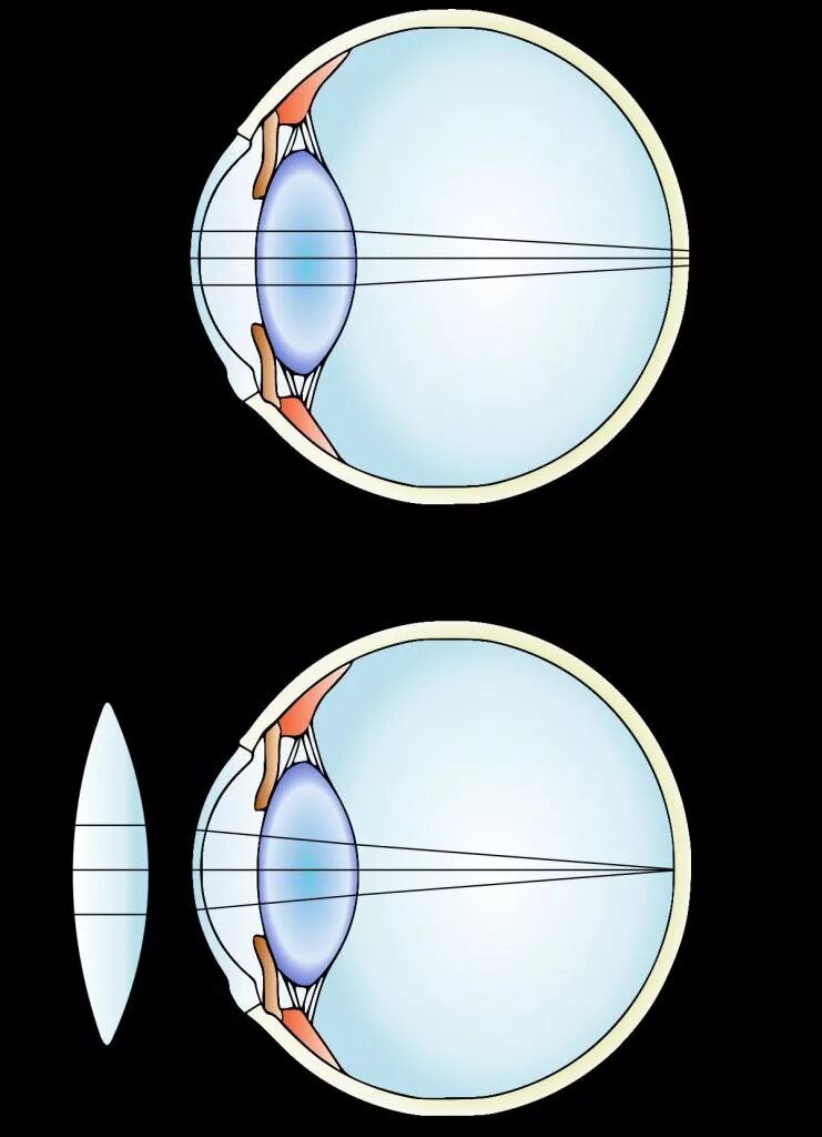 Линзы для зрения дальнозоркость. Миопия и гиперметропия линзы. Близорукость и дальнозоркость линзы. Линзы при гиперметропии. Миопия глаза дальнозоркость.