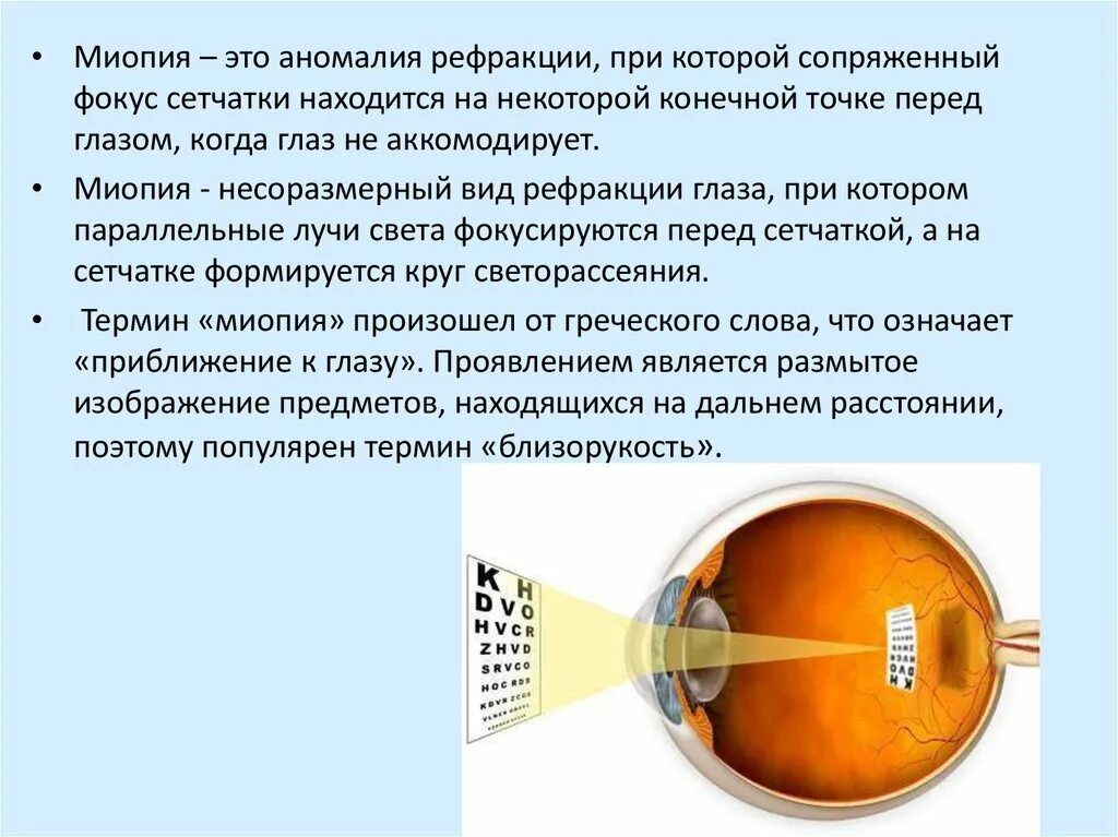 Миопия. Близорукость обоих глаз. Мтопи. Перед сетчаткой расположена