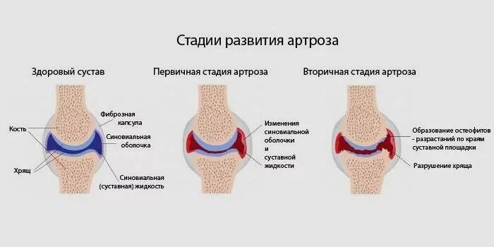 Артроз какой степени. Деформирующий артроз коленного сустава схема. деформирующий артроз 1-2 степени. артрит коленного сустава схема. стадии развития деформирующего остеоартроза.