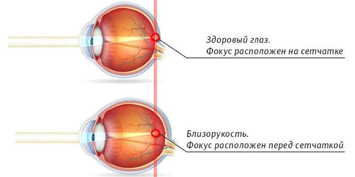 Близорукость (истинная и ложная формы патологии). Миопия фокус перед сетчаткой. Близорукость глазное яблоко удлиняется. Удлиненное глазное яблоко при близорукости. Близорукость причины возникновения