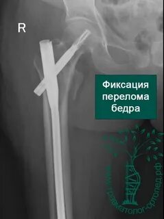Код мкб перелом бедра