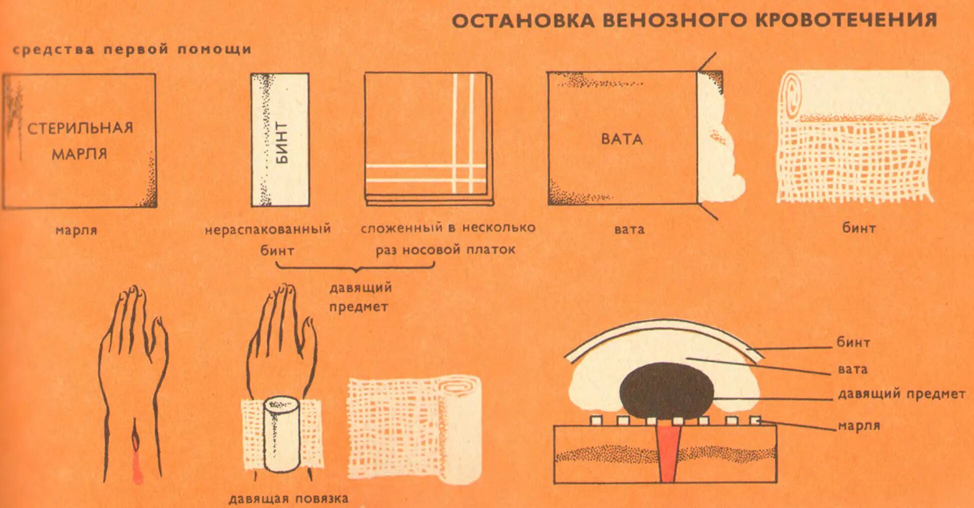 Как остановить обильное кровотечение тест. Способы остановки венозного кровотечения кратко. Для остановки венозного кровотечения используется. Остановка наружного венозного кровотечения алгоритм. Для временной остановки венозного кровотечения используется.