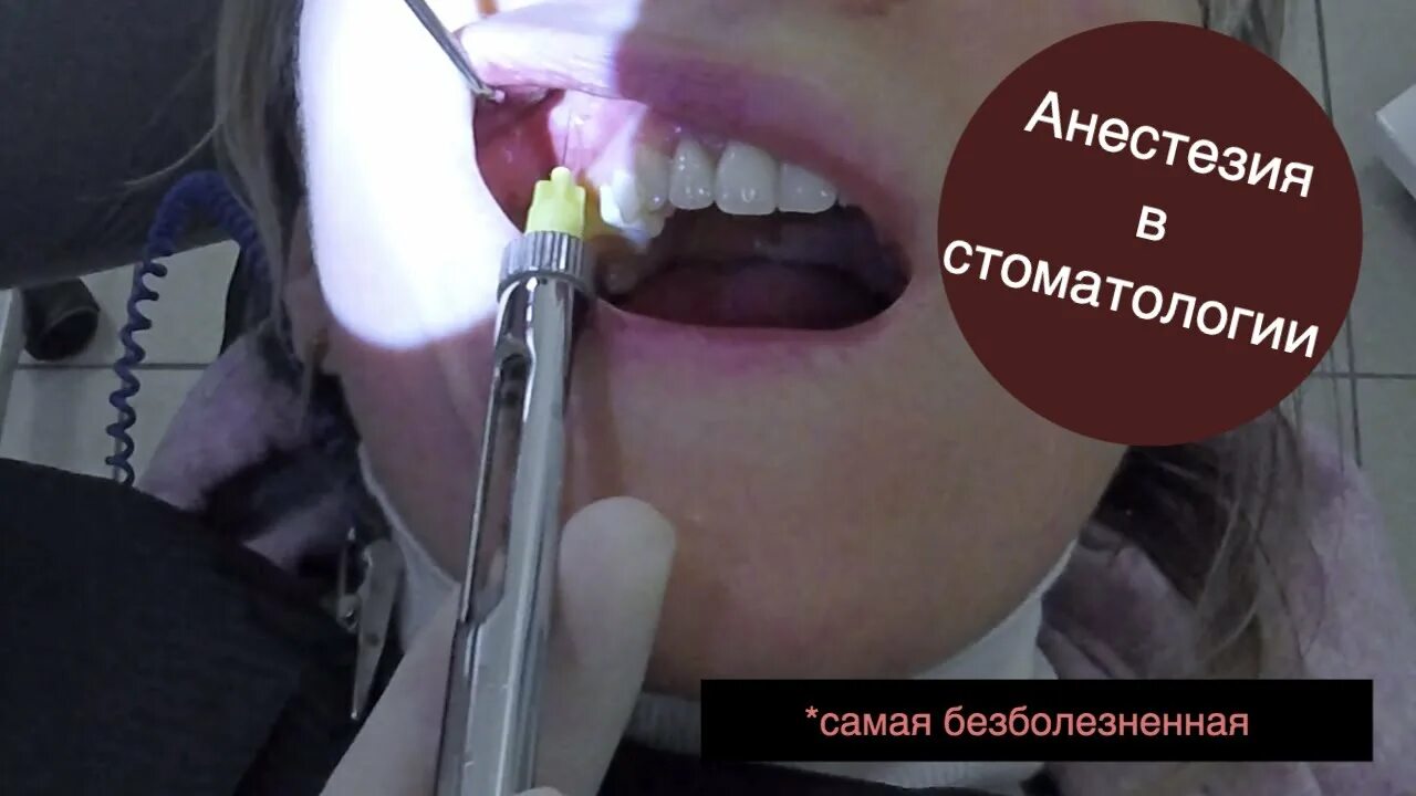 Анестезия в стоматологии. Самая безболезненная ИНФИЛЬТРАЦИОННАЯ анестезия - YouT
