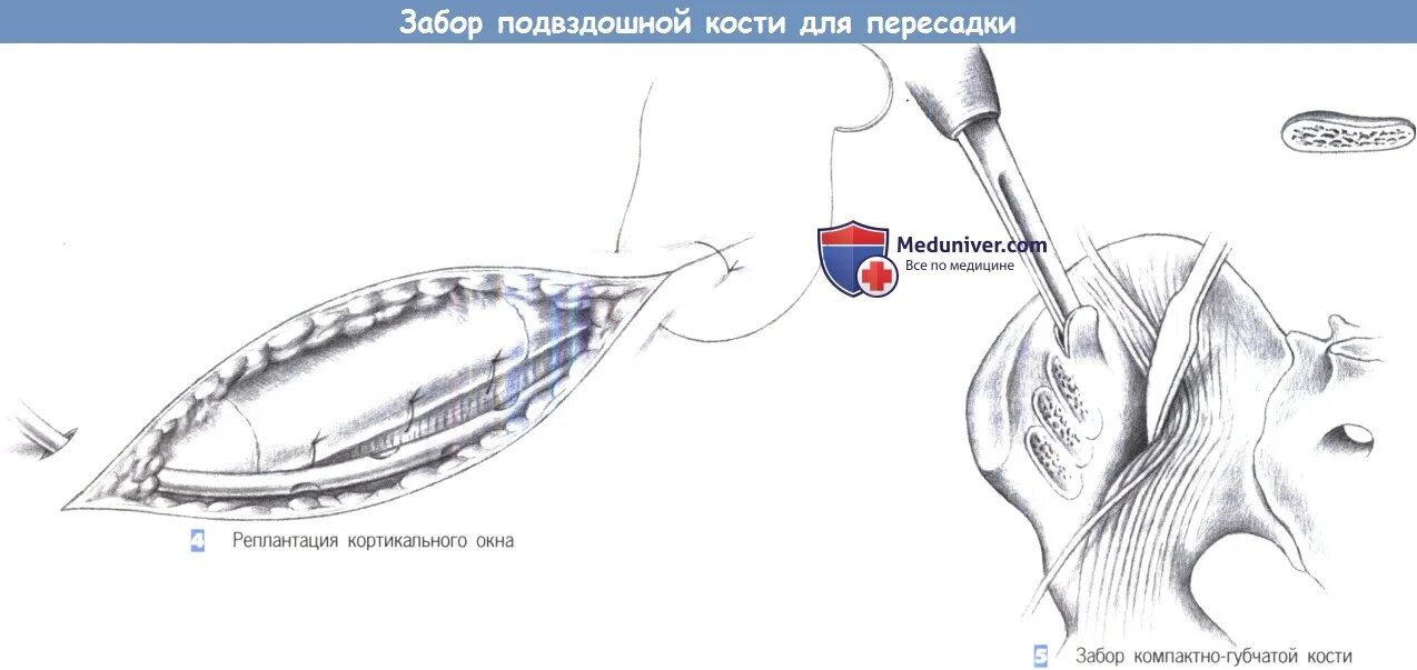 Забор трансплантата из крыла подвздошной кости. Забор костного трансплантата из крыла подвздошной кости. Взятие трансплантата из подвздошной кости. Техника взятия трансплантата из гребня подвздошной кости.