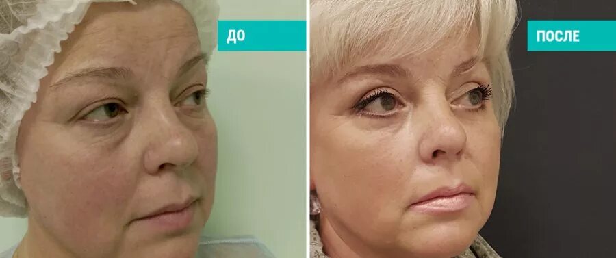 татьяна германовна блефаропластика. доктор топорков блефаропластика. кудинова екатерина сергеевна пластический хирург блефаропластика. бурмистрова пластический хирург. блефаропластика в щелково врачи.