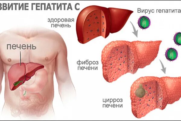 Вид печени при гепатите. Полное излечение гепатита б