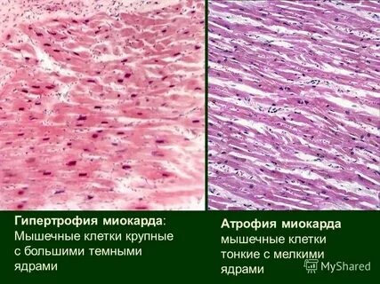 Гипертрофия препарат