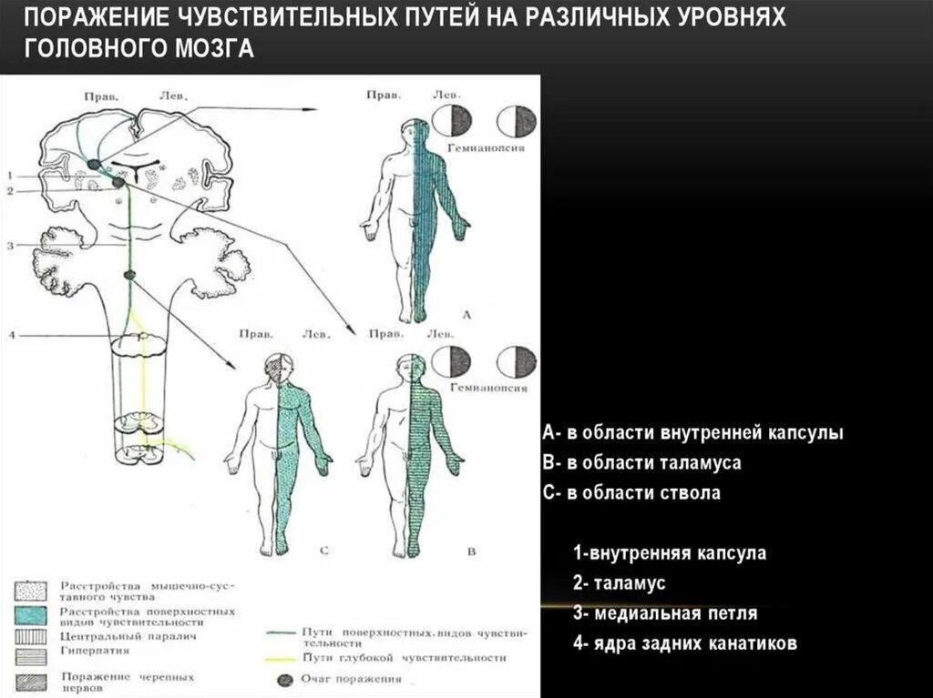 Двигательные симптомы поражения. Расстройства чувствительности при поражении внутренней капсулы. Синдром поражения внутренней капсулы головного мозга. Поражение двигательного анализатора схема. Типы нарушения чувствительности.