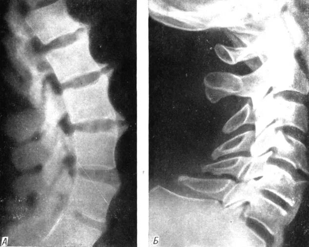 шейный остеохондроз 1 период. остеофиты шейного отдела позвоночника рентген. остеохондроз шейного отдела позвоночника с3-с7. остеохондроз грудного отдела позвоночников 1 2-3 степени. шейный остеохондроз 1 период.