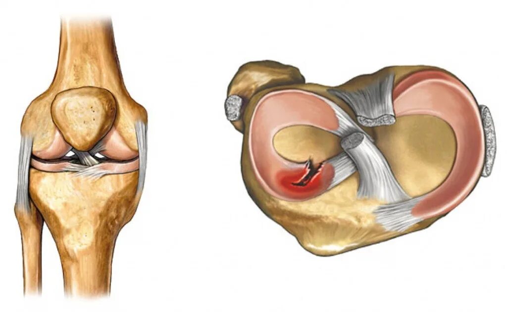 Разрыв медиального мениска. Повреждение медиального мениска коленного. Разрыв латерального мениска. Задний Рог медиального мениска. Поврежденный мениск коленного сустава