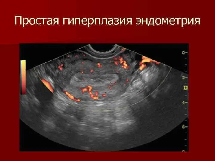 Эндометрия разрастается. Гиперплазия эндометрия. Эхография гиперплазии эндометрия.