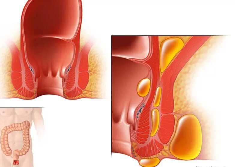Anal Cancer: Are You at Risk? Manhattan Gastroenterology