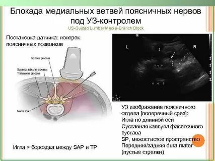 Блокада под узи