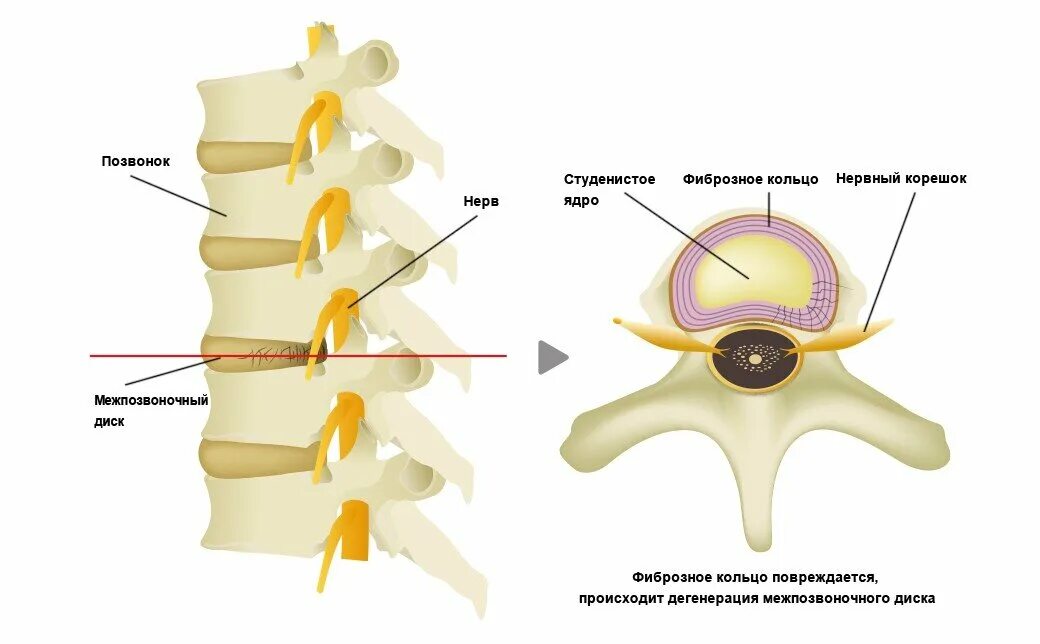 Пульпозное ядро межпозвоночного диска. Дугоотростчатые межпозвонковые суставы. Пульпозное ядро и фиброзное кольцо. Ядро позвонка. Межпозвоночны йдиски состояит их.