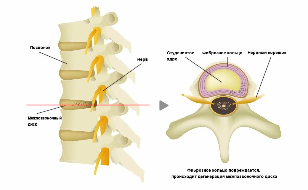 Спинной форум. Студенистое ядро межпозвоночного диска. Межпозвонковый диск студенистое ядро. Фиброзное кольцо и студенистое ядро. Фиброзное кольцо межпозвоночного диска студенистое.