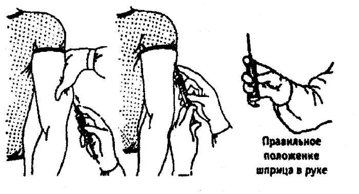 Укол подкожно в плечо техника. Укол подкожно в плечо техника выполнения. Подкожная инъекция в плечо алгоритм. Шприц подкожная инъекция техника.