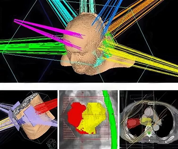 Конформная лучевая. Гамма излучение лучевая терапия. IMRT лучевая терапия. Аппарат внутриполостной лучевой терапии. Трехмерная конформная лучевая терапия (3d-CRT).