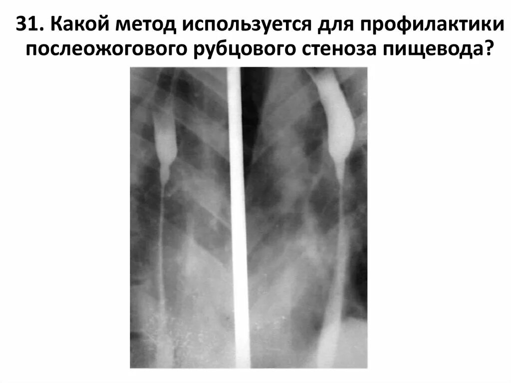 Сужение пищевода симптомы. Стриктура пищевода рентген. Рубцовая стриктура пищевода рентген. Послеожоговые стриктуры пищевода схема. Постожоговые стриктуры пищевода.