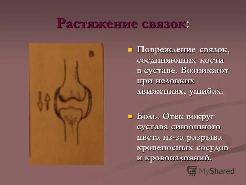 Растяжение связок вывихи и переломы таблица. Что может вызвать неловкое движение в суставе. Неловкое движение может вызвать в суставе. Что может вызвать неловкое движение в суставе. Компрессия конского хвоста симптомы.