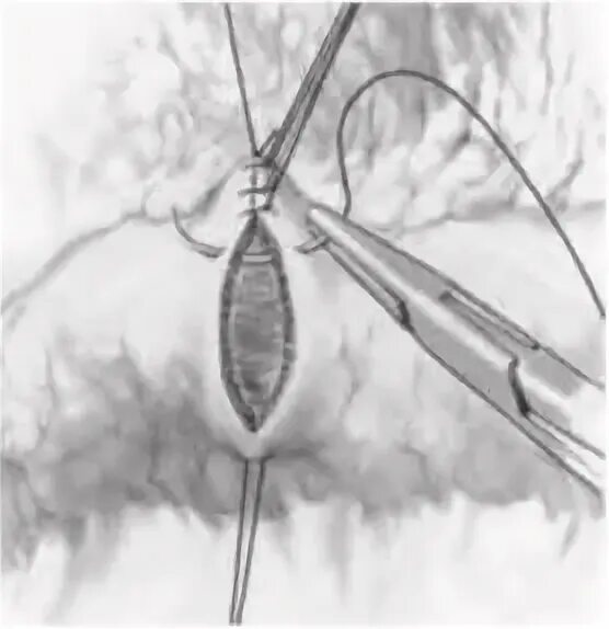 Переходящая операция