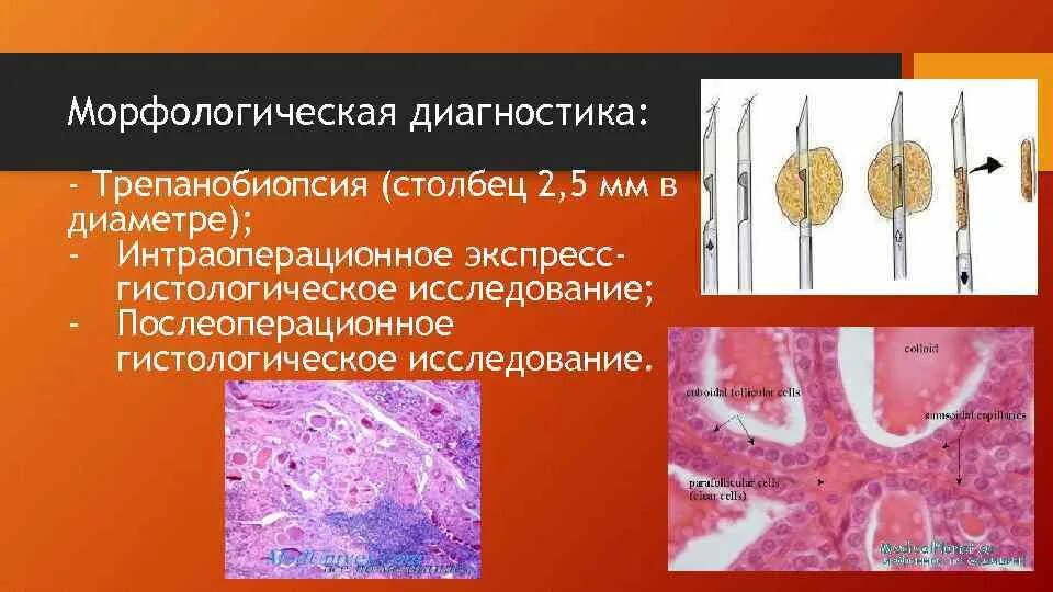 После трепанобиопсии. Трепанобиопсия костного мозга. Осложнения трепанобиопсии. Билатеральная трепанобиопсия что. Морфологическая диагностика.