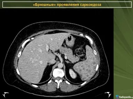 Саркоидоз кт