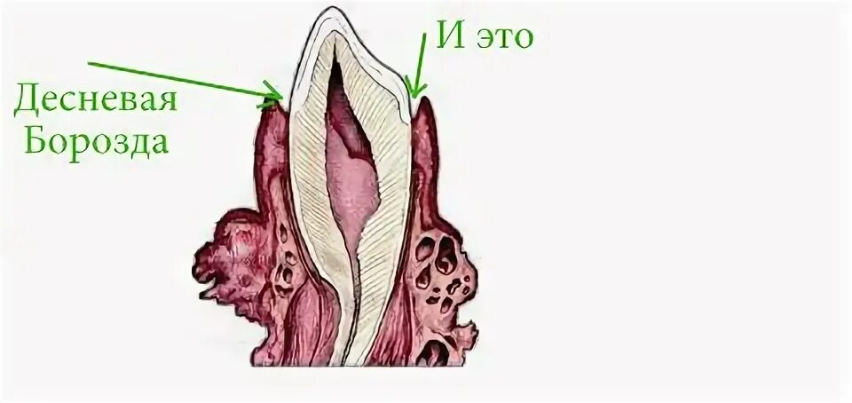 Строение зубодесневой борозды. Строение десневой борозды. Десневой Желобок (десневая борозда). Морфология зубодесневой борозды.