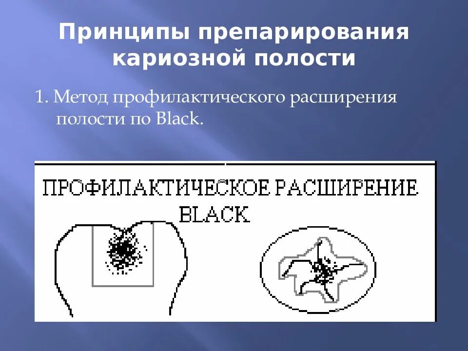 Принципы препарирования полостей. Принципы препарирования. принципы препарирования кариозных полостей. метод профилактического расширения по блэку. метод профилактического расширения кариозной полости.