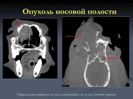 Доброкачественные опухоли пазух носа