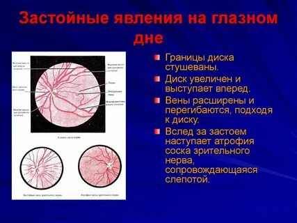 Боли глазном дне