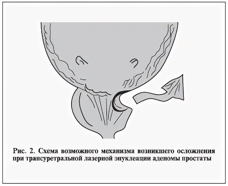 Схема простаты