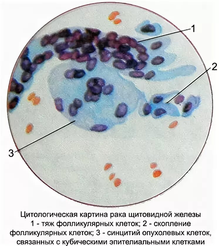 Атипия фолликулярных клеток