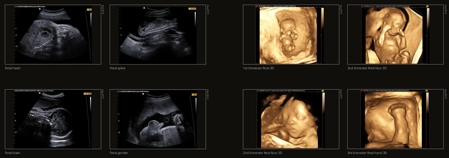 Узи беременности 3 скрининг. 32 Неделя беременности скрининг УЗИ. УЗИ плода 2 триместр беременности скрининг. УЗИ 3 скрининг 32 недели беременности. Второй скрининг на 20 неделе беременности.