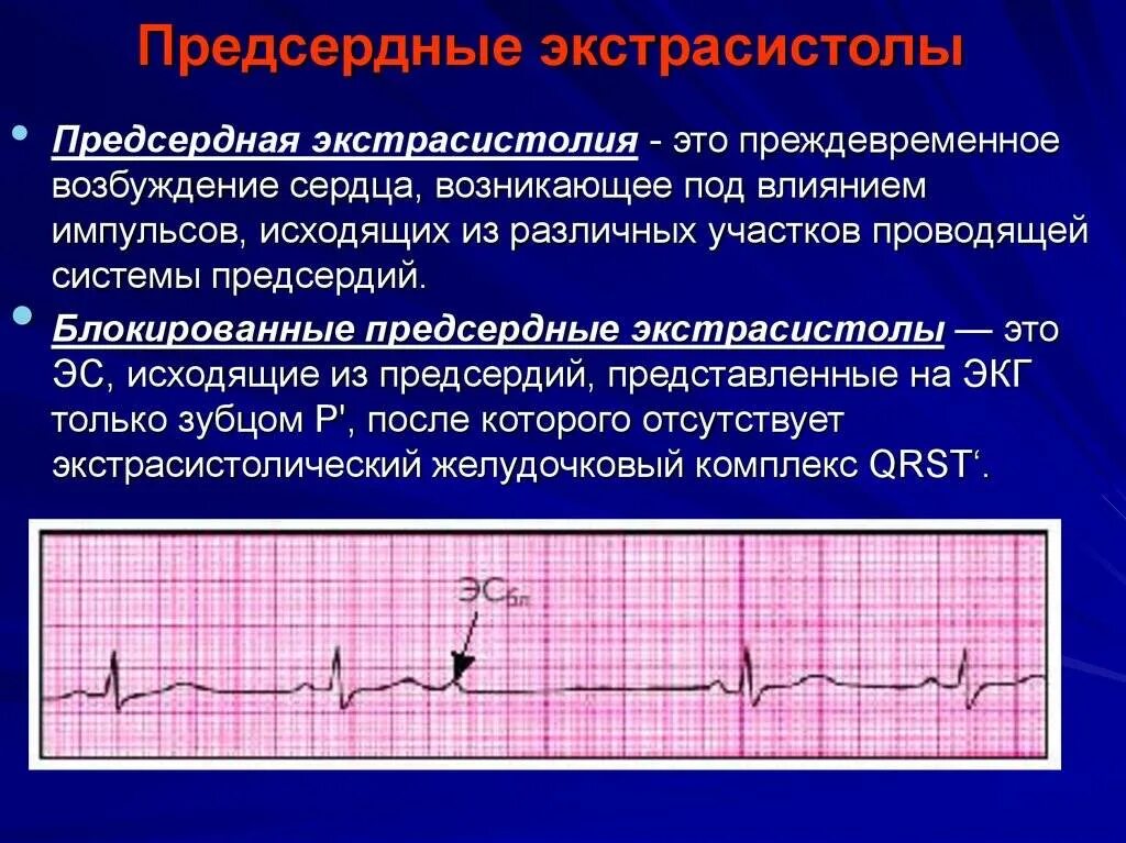 Можно ли вылечить экстрасистолию полностью