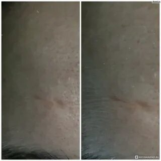 Рубцы контрактубекс