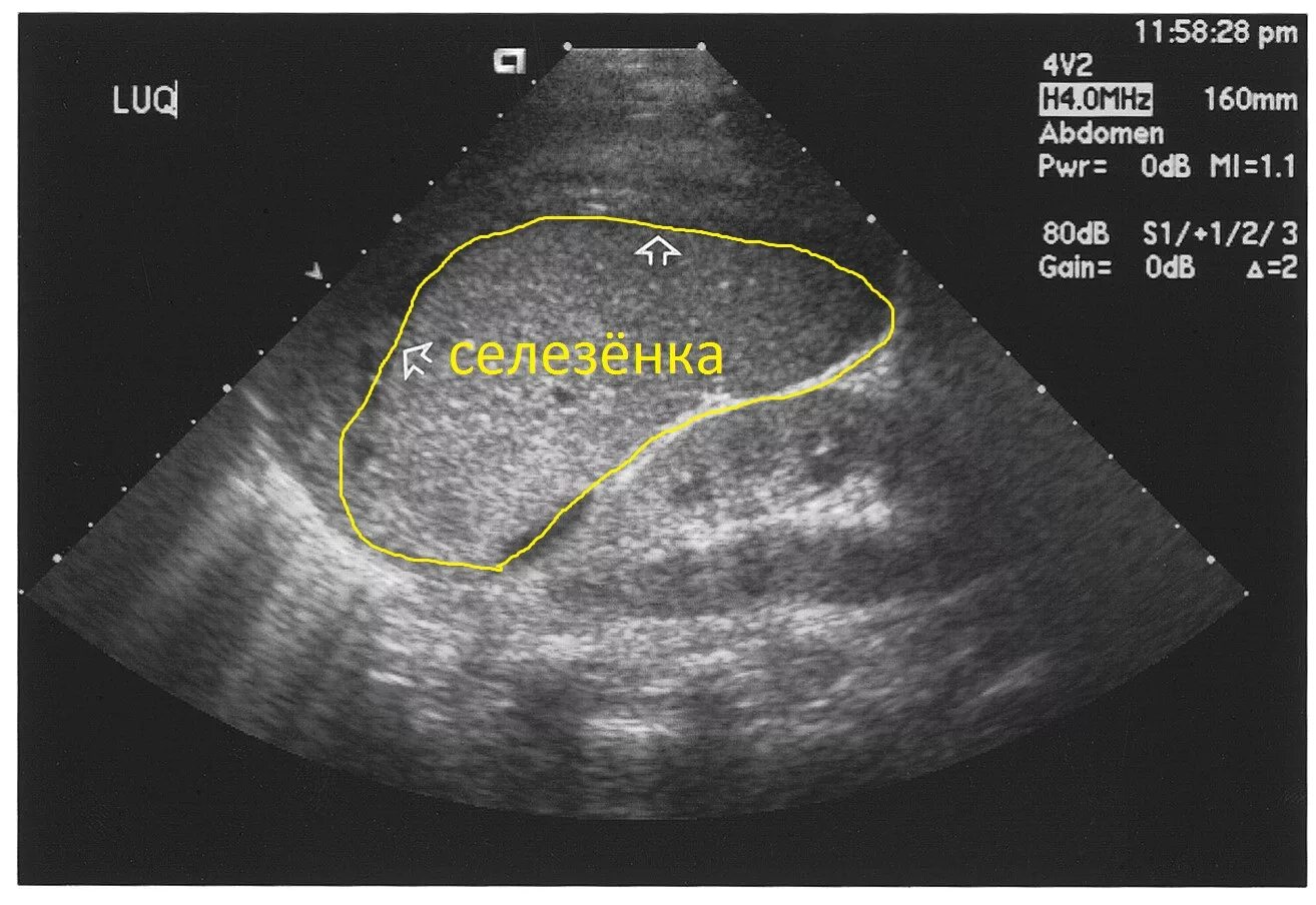 Кальцинаты селезенки. УЗИ печени селезенки почек. УЗИ брюшной полости селезенка. УЗИ селезенки норма.