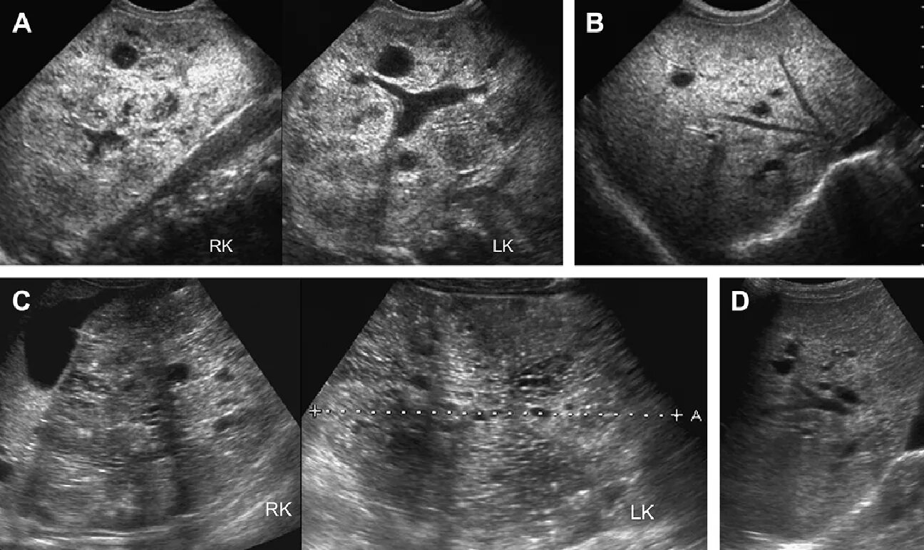 Образование в печени на узи. Непаразитарные кисты печени. Паразитарные кисты печени на УЗИ. Подкапсульная киста печени. Непаразитарные кисты печени УЗИ.