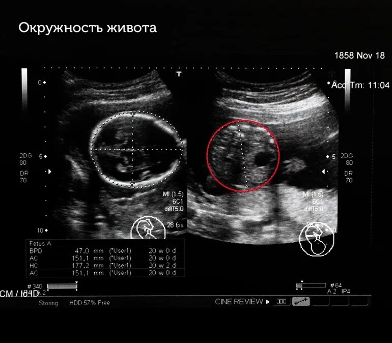 УЗИ параметры головы плода. УЗИ 11 недель окружность головы плода. Ультразвуковая фетометрия плода норма. Норма бипариетального размера головы плода.