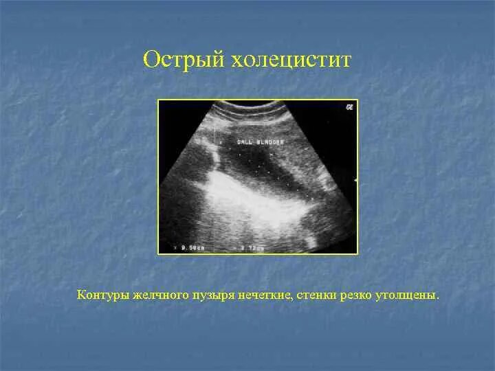 Изменение стенок желчного пузыря. Острый калькулезный холецистит на УЗИ. Острый деструктивный холецистит УЗИ. ЖКБ острый калькулезный холецистит УЗИ. УЗИ желчного пузыря острый холецистит.