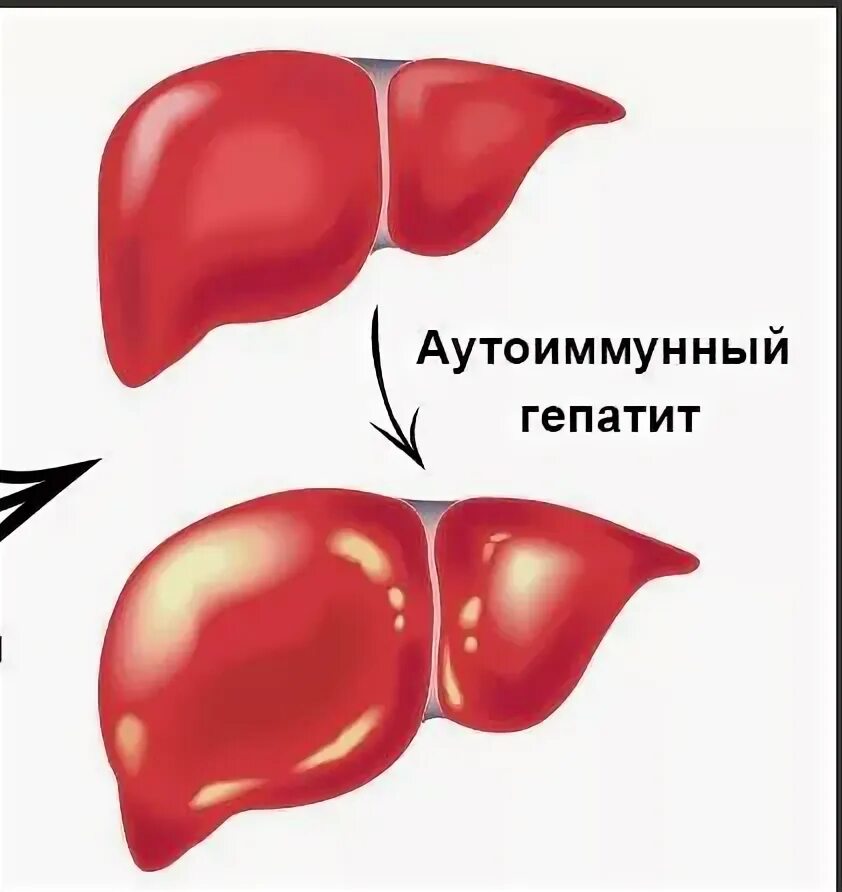 Аутоиммунная печени. Аутоиммунный гепатит. Хронический аутоиммунный гепатит патогенез. Печень при аутоиммунном гепатите. Аутоиммунные заболевания печени у детей.