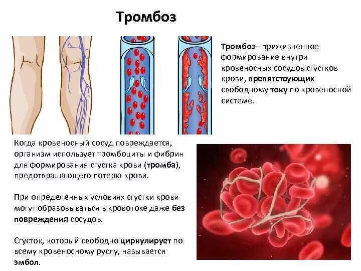 Тромбофлебит артерий. Тромбофлебит кровеносного сосуда.