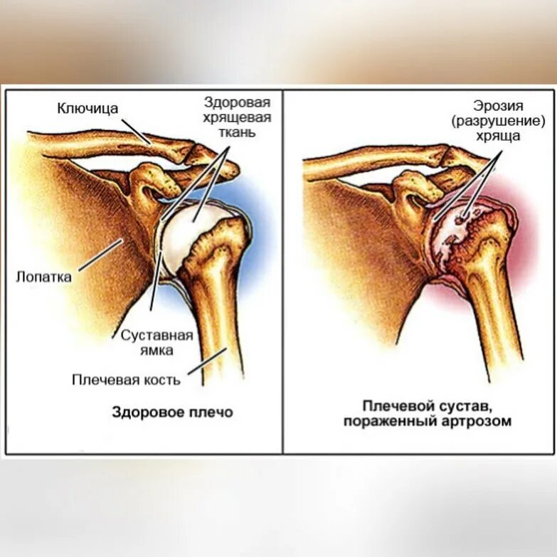 Ноющая боль в плече. Ревматоидный артрит плечевого сустава. Артропатия сустава плеча плечевого. Суставная щель плечевого сустава. Деформирующий остеоартроз плечевого сустава.