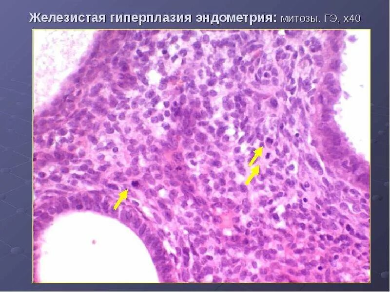 Сложная гиперплазия эндометрия. Гиперплазия эндометрия гистероскопия. Железистая гиперплазия. Гиперплазия эндометрия митозы. Митозы в эпителии эндометрия что это.