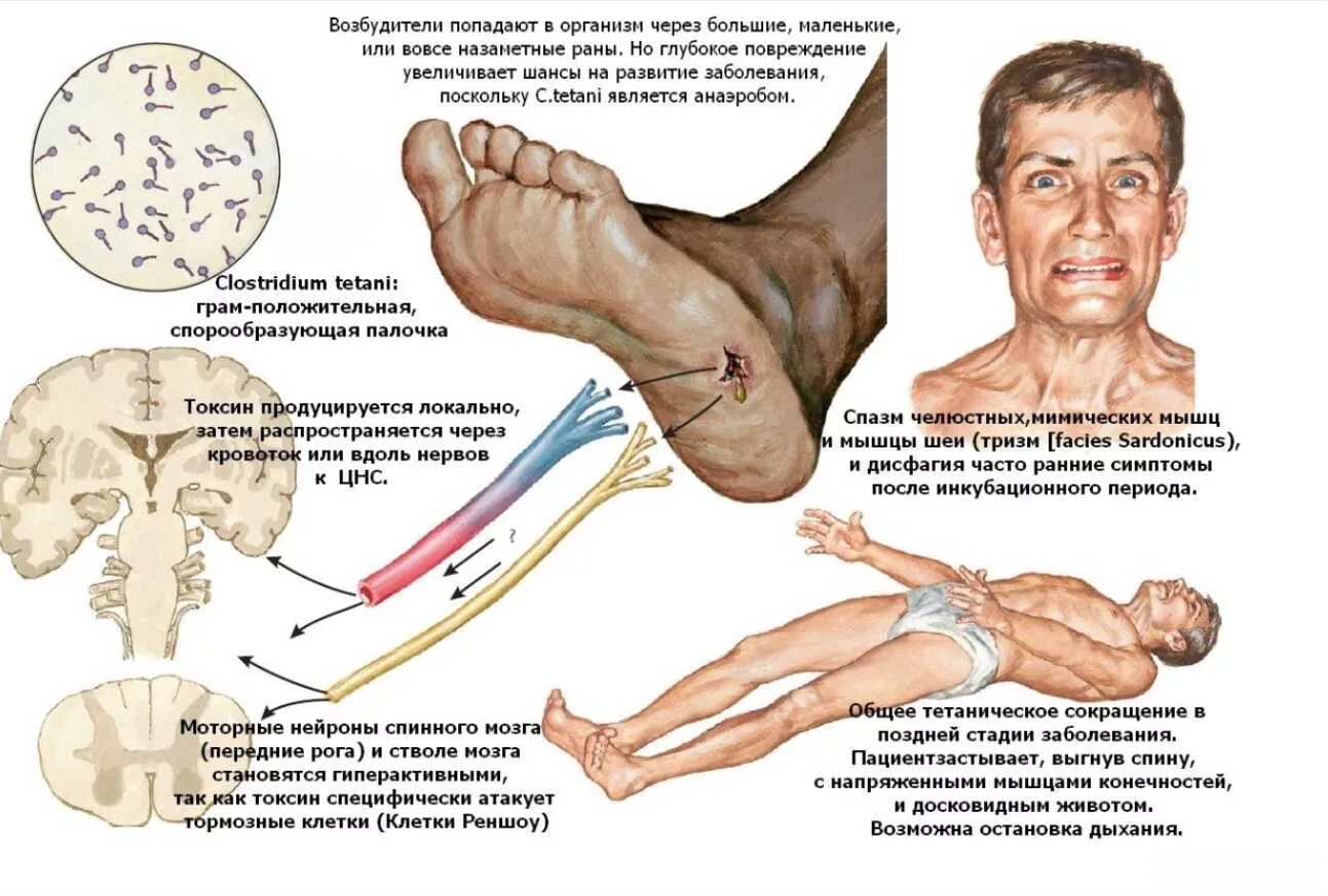 Столбняк механизм передачи возбудителя. Столбняк источники и пути заражения. Болезнь столбняк симптомы. Столбняк механизм и путь передачи. Столбняк 3 основных симптома.