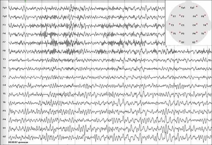Пароксизмальная ээг. Эпилептиформная активность на ЭЭГ. Пароксизмальная активность на ЭЭГ. Полипик волна на ЭЭГ. Эпилептиформные паттерны на ЭЭГ.